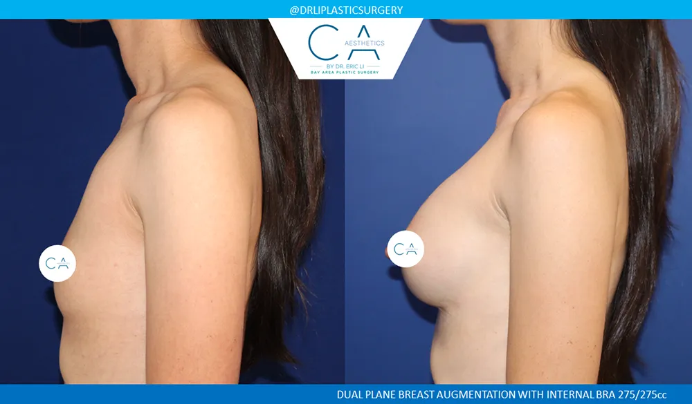 Breast Augmentation case #8997