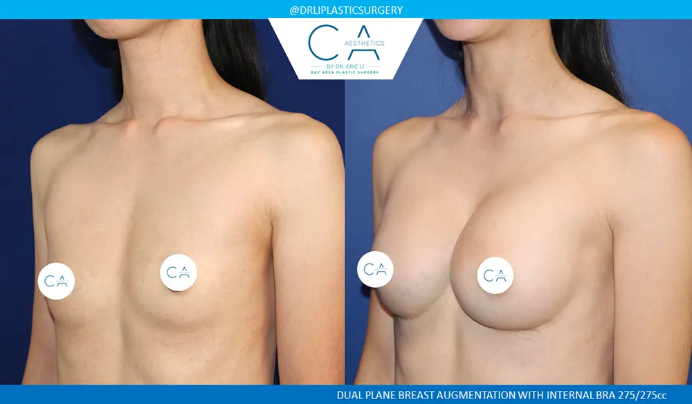 Breast Augmentation case #8997