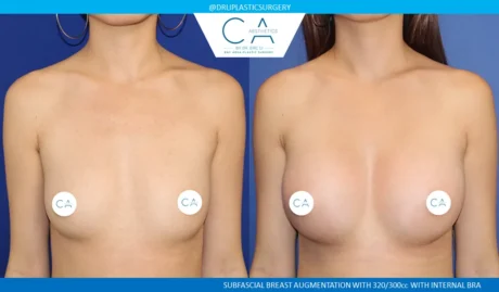 Breast Augmentation case #9001