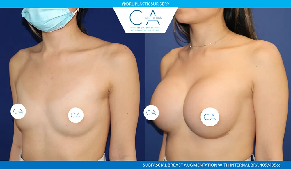Breast Augmentation case #9005