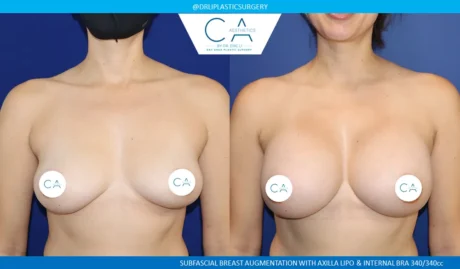 Breast Augmentation case #9009