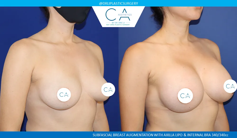 Breast Augmentation case #9009