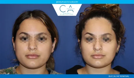 Buccal Fat Removal case #9055