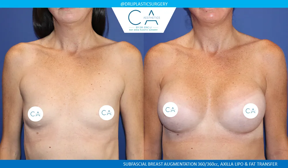 Breast Augmentation case #9013
