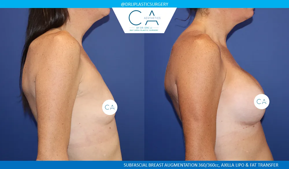 Breast Augmentation case #9013