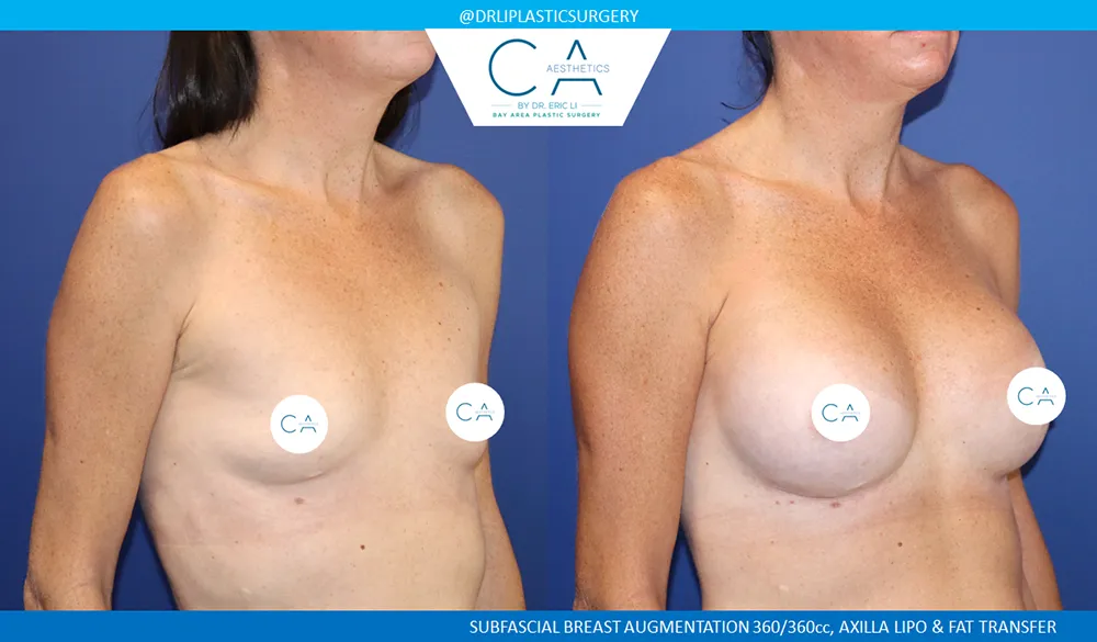 Breast Augmentation case #9013