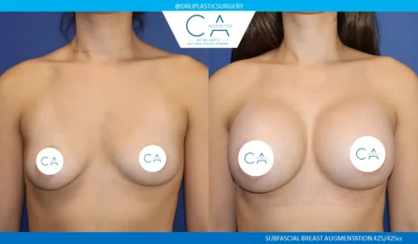 Breast Augmentation case #9021