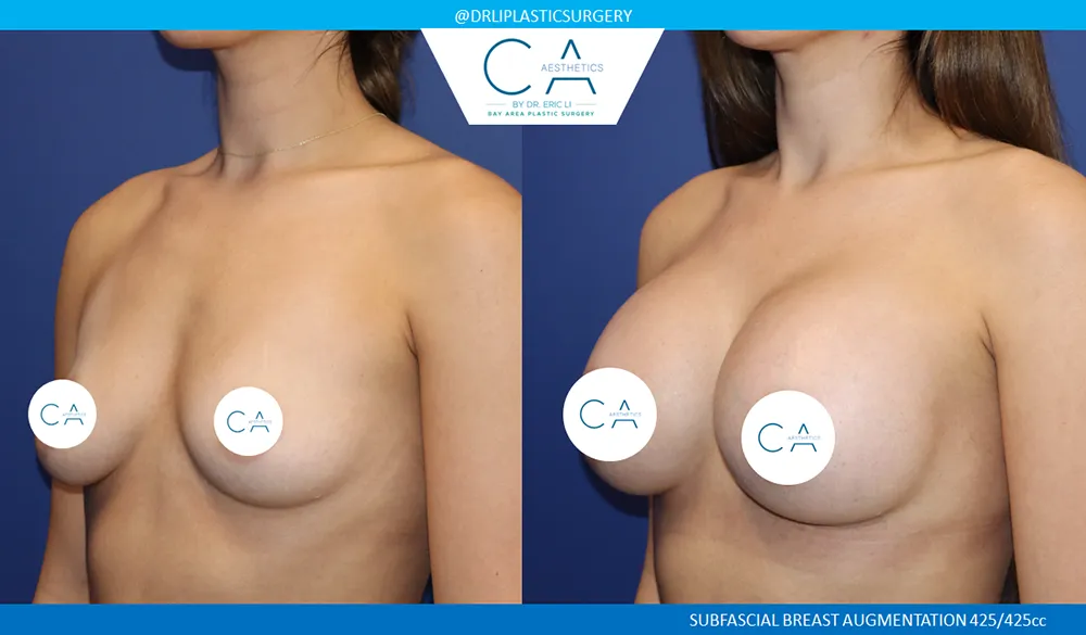 Breast Augmentation case #9021