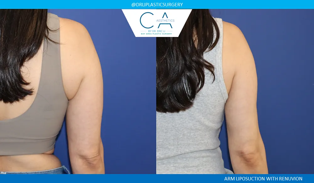 Arm Liposuction case #8970