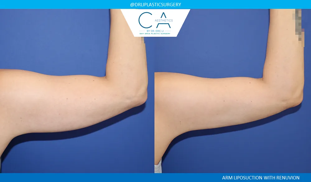Arm Liposuction case #8970