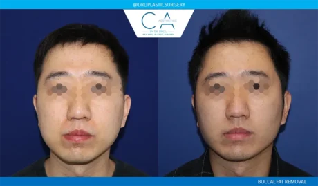 Buccal Fat Removal case #9058