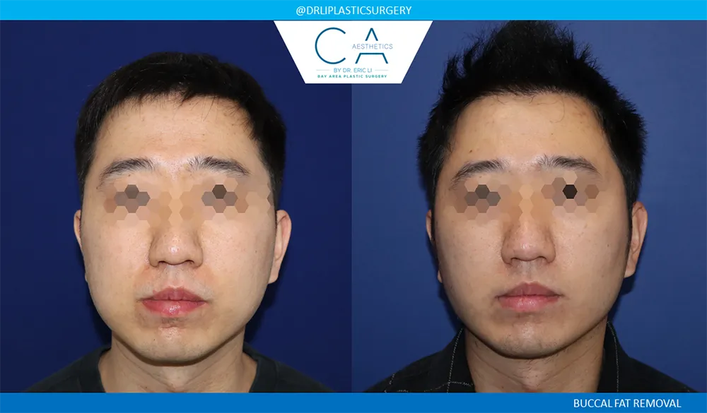 Buccal Fat Removal case #9058