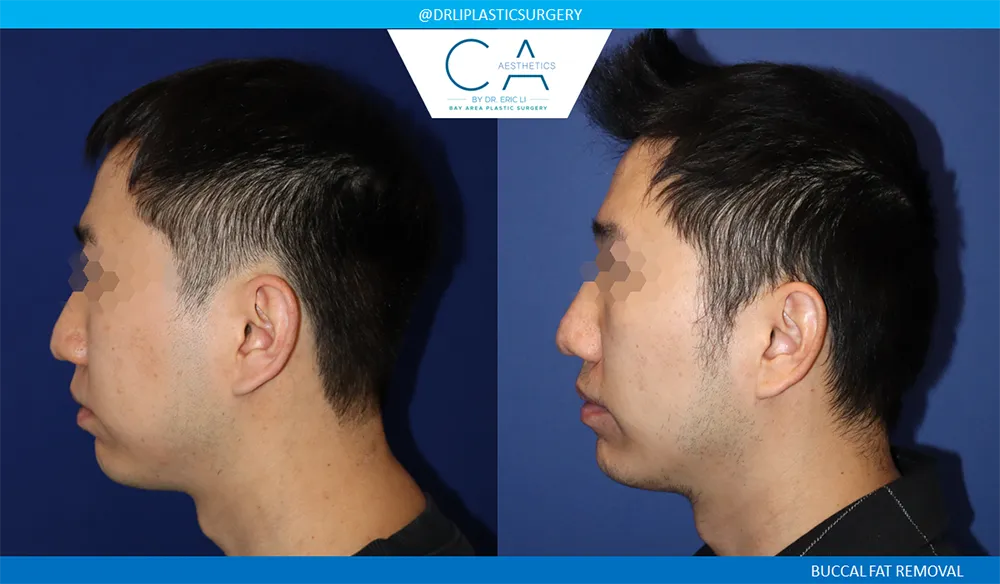 Buccal Fat Removal case #9058