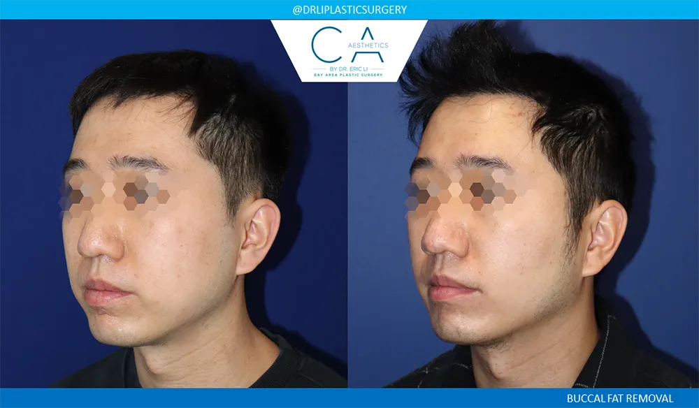 Buccal Fat Removal case #9058