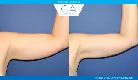 Arm Liposuction case #8967