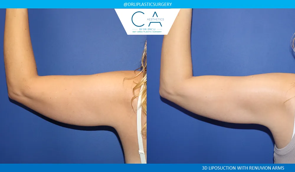 Arm Liposuction case #8967