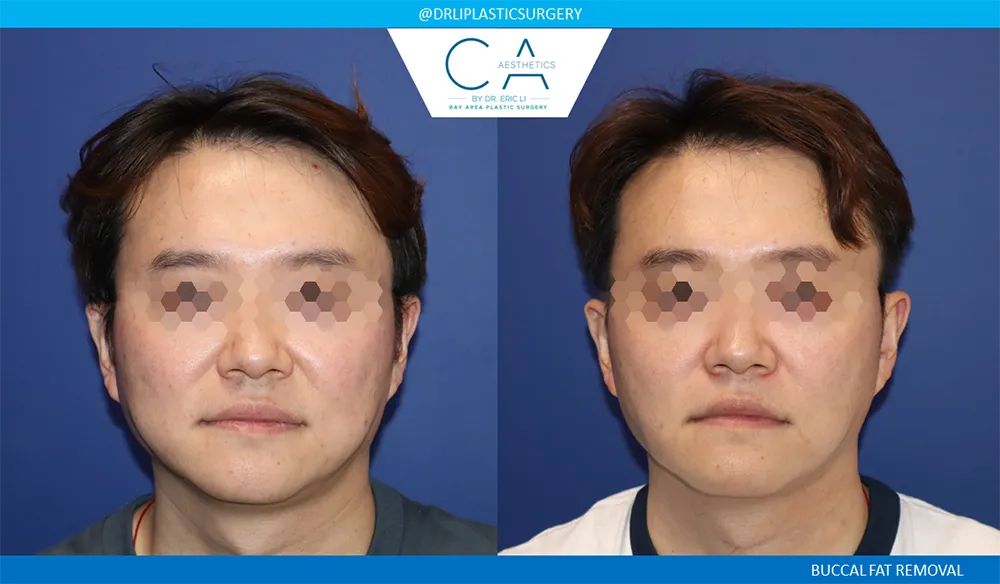 Buccal Fat Removal case #9062