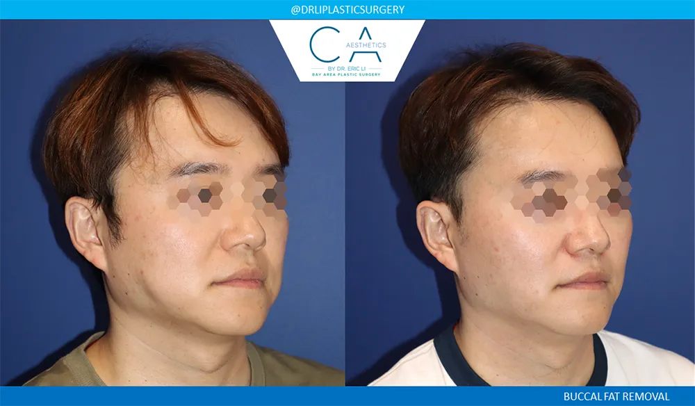 Buccal Fat Removal case #9062