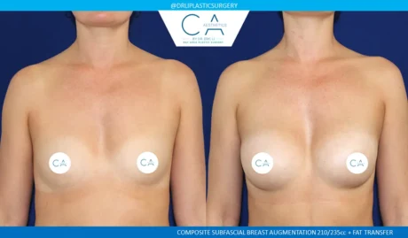 Fat Transfer Breast Augmentation case #9138