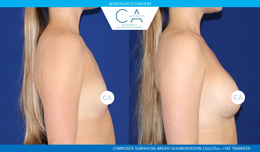Fat Transfer Breast Augmentation case #9138
