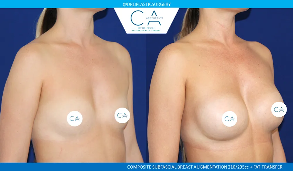Fat Transfer Breast Augmentation case #9138