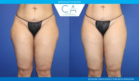 Leg Liposuction case #9110