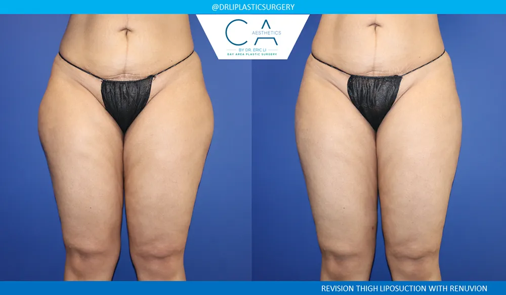 Leg Liposuction case #9110