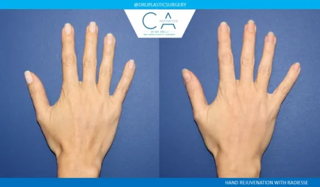 Hand Rejuvenation case #9103