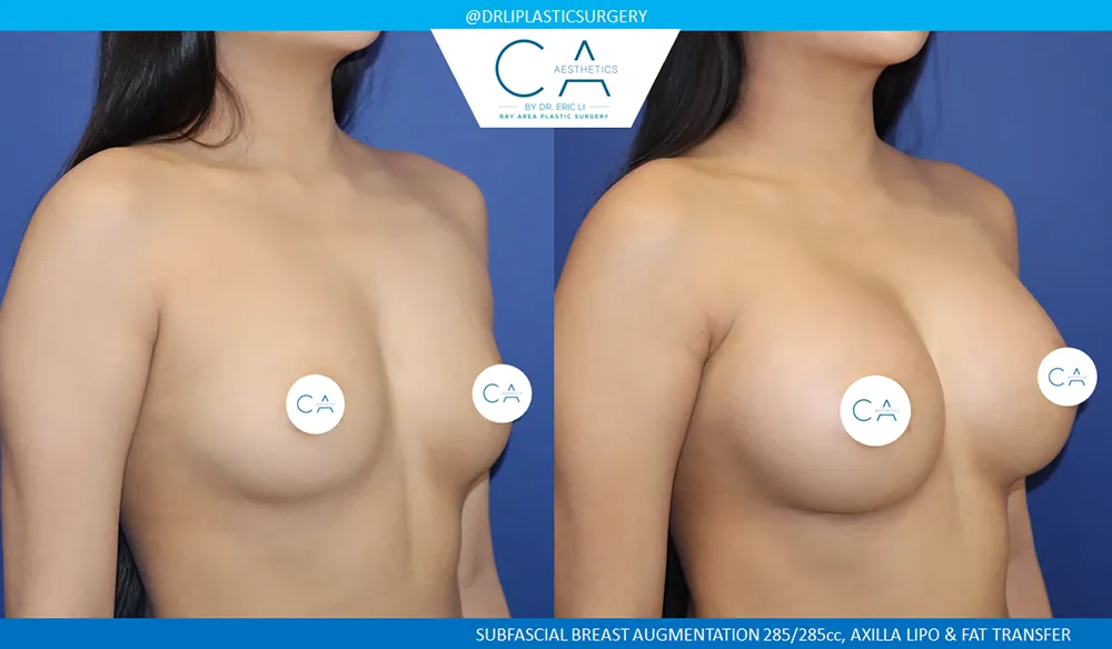 Breast Augmentation case #8986