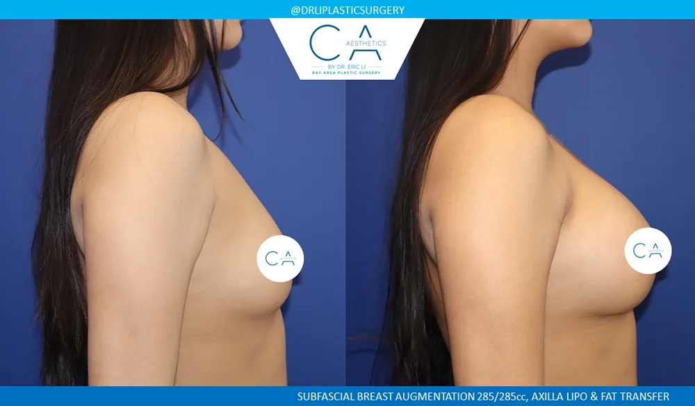 Breast Augmentation case #8986
