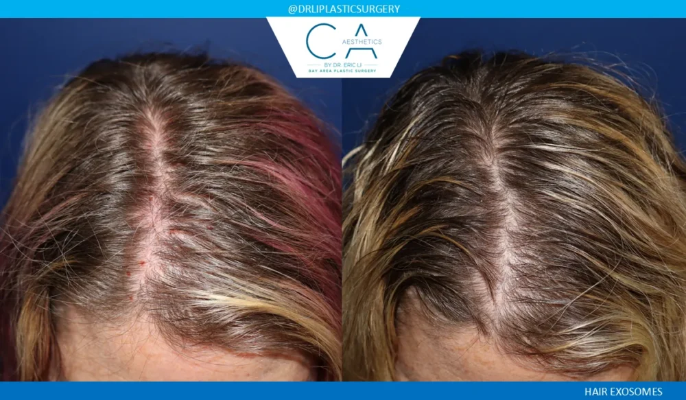 Hair Exosomes case #9269