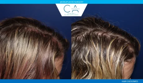 Hair Exosomes case #9271