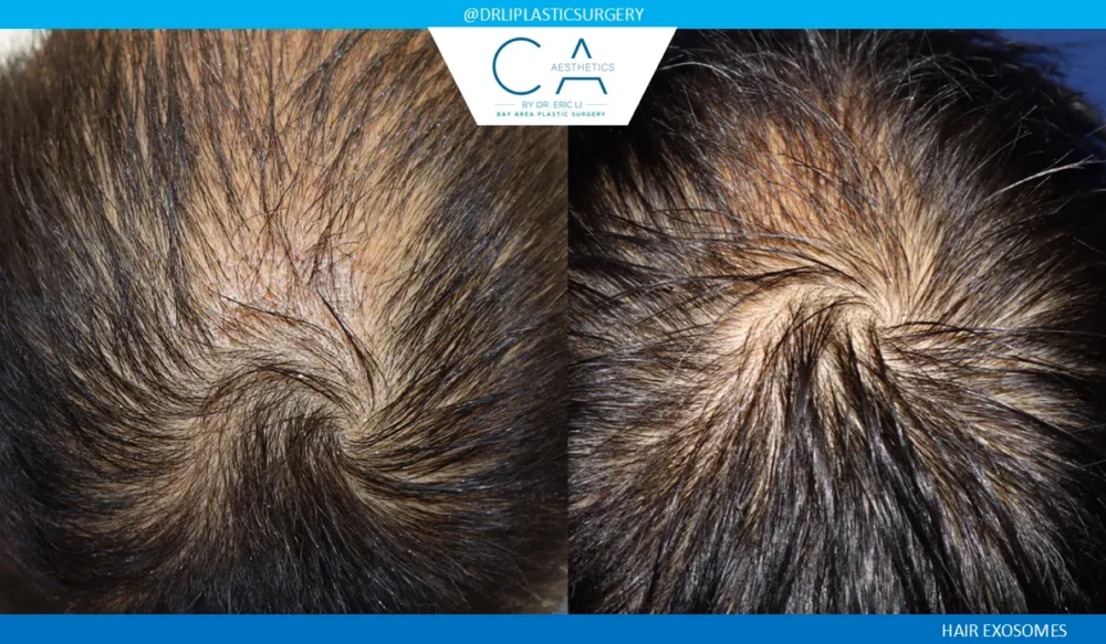 Hair Exosomes case #9273