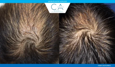 Hair Exosomes case #9273