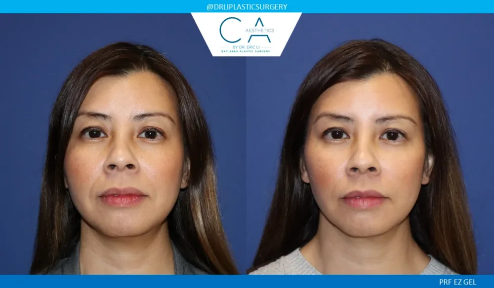 PRF EZ Gel case #9276