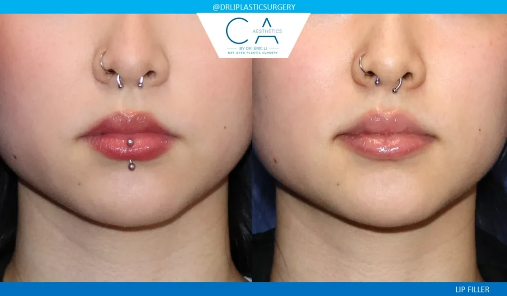 Fillers case #9265