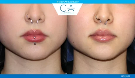 Fillers case #9265