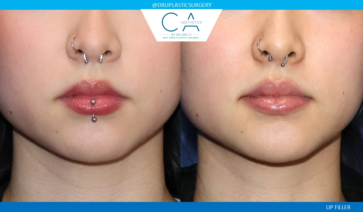 LIP FILLER-1