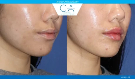 Fillers case #9267