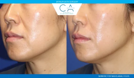 Fillers case #9263