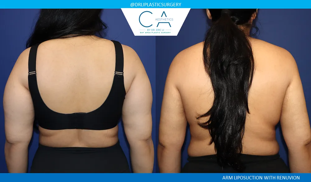 Arm Liposuction case #9628