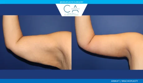 Arm Lift (Brachioplasty) case #9623