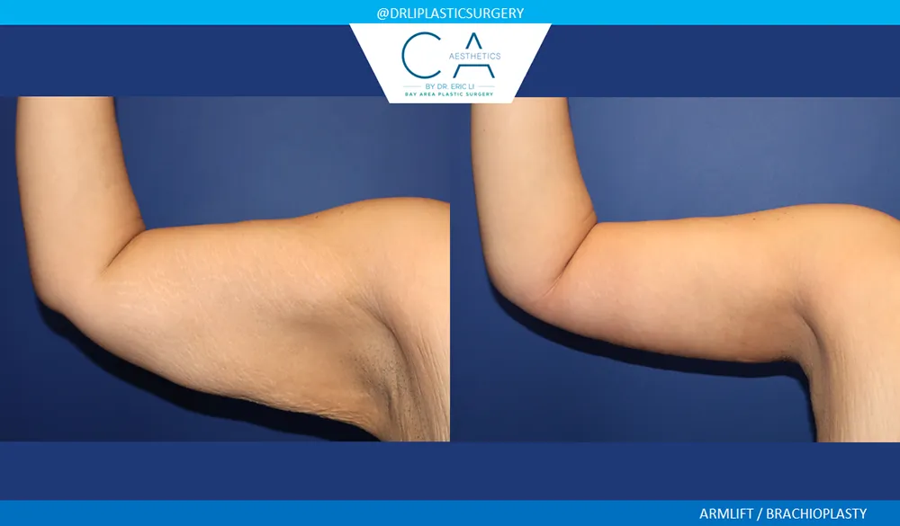 Arm Lift (Brachioplasty) case #9623