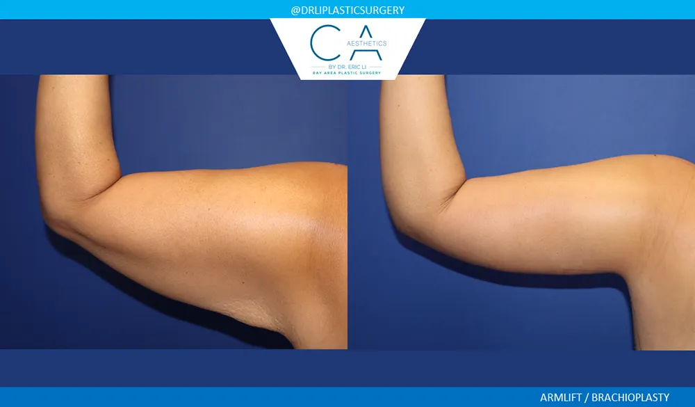 Arm Lift (Brachioplasty) case #9623