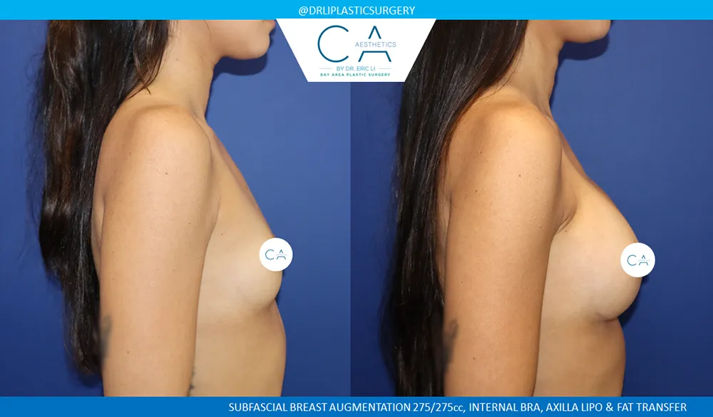 Asian Breast Augmentation case #9589
