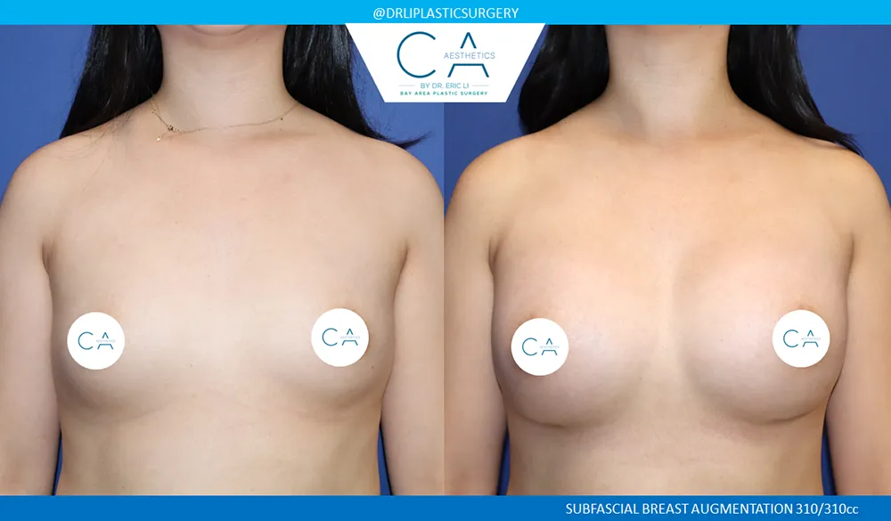 Asian Breast Augmentation case #9574
