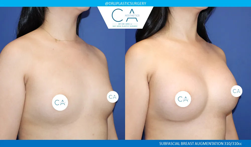 Asian Breast Augmentation case #9574
