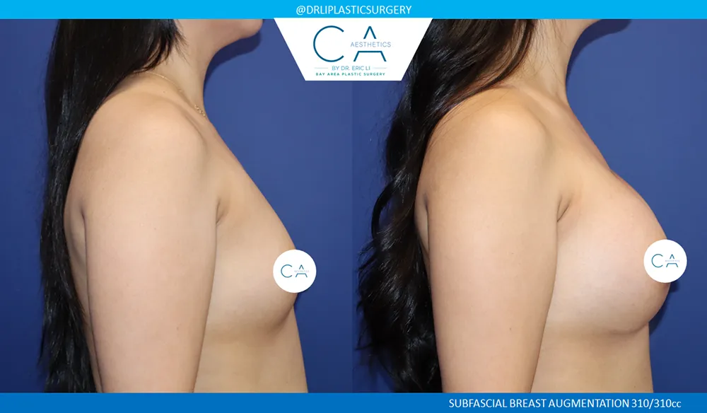 Asian Breast Augmentation case #9574