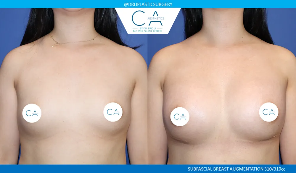 Asian Breast Augmentation case #9574