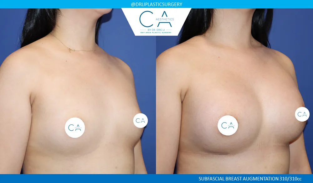 Asian Breast Augmentation case #9574